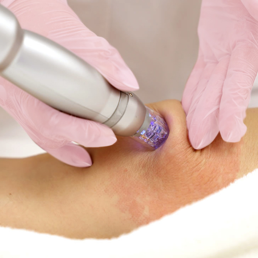 Микроигольчатый RF-лифтинг тела на аппарате Scarlet S