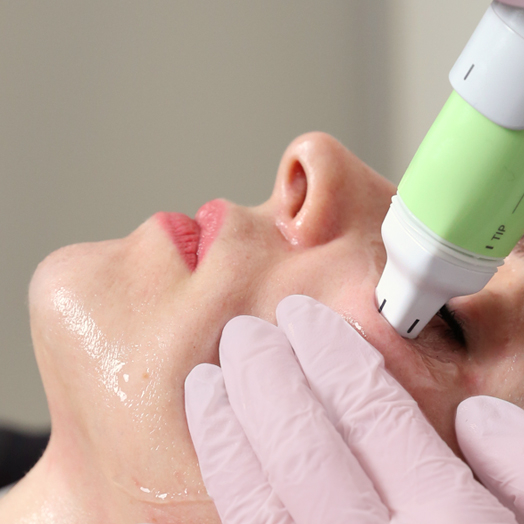 Монополярный RF-лифтинг на аппарате Volnewmer