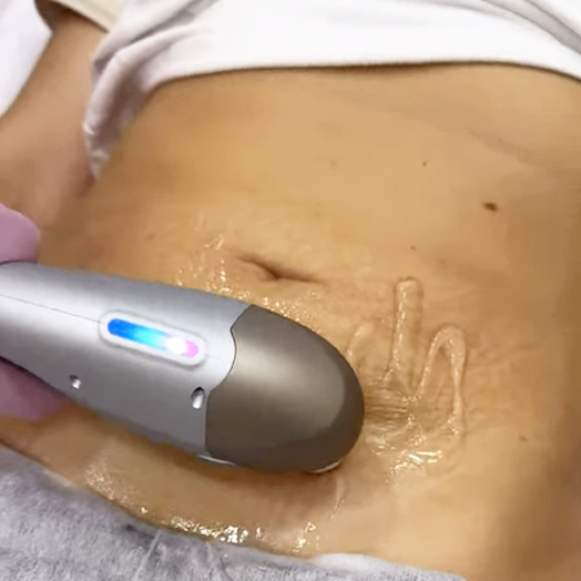 SMAS-лифтинг тела на аппарате Ultraformer